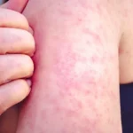 measles symptoms adults